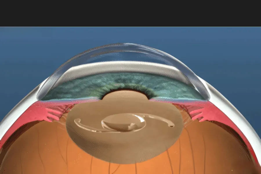 The Art of Lens Replacement in Istanbul