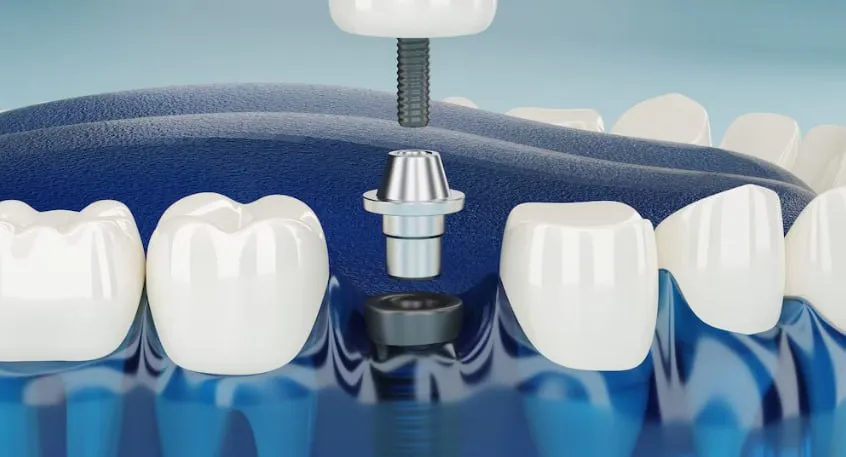 Dental Implants