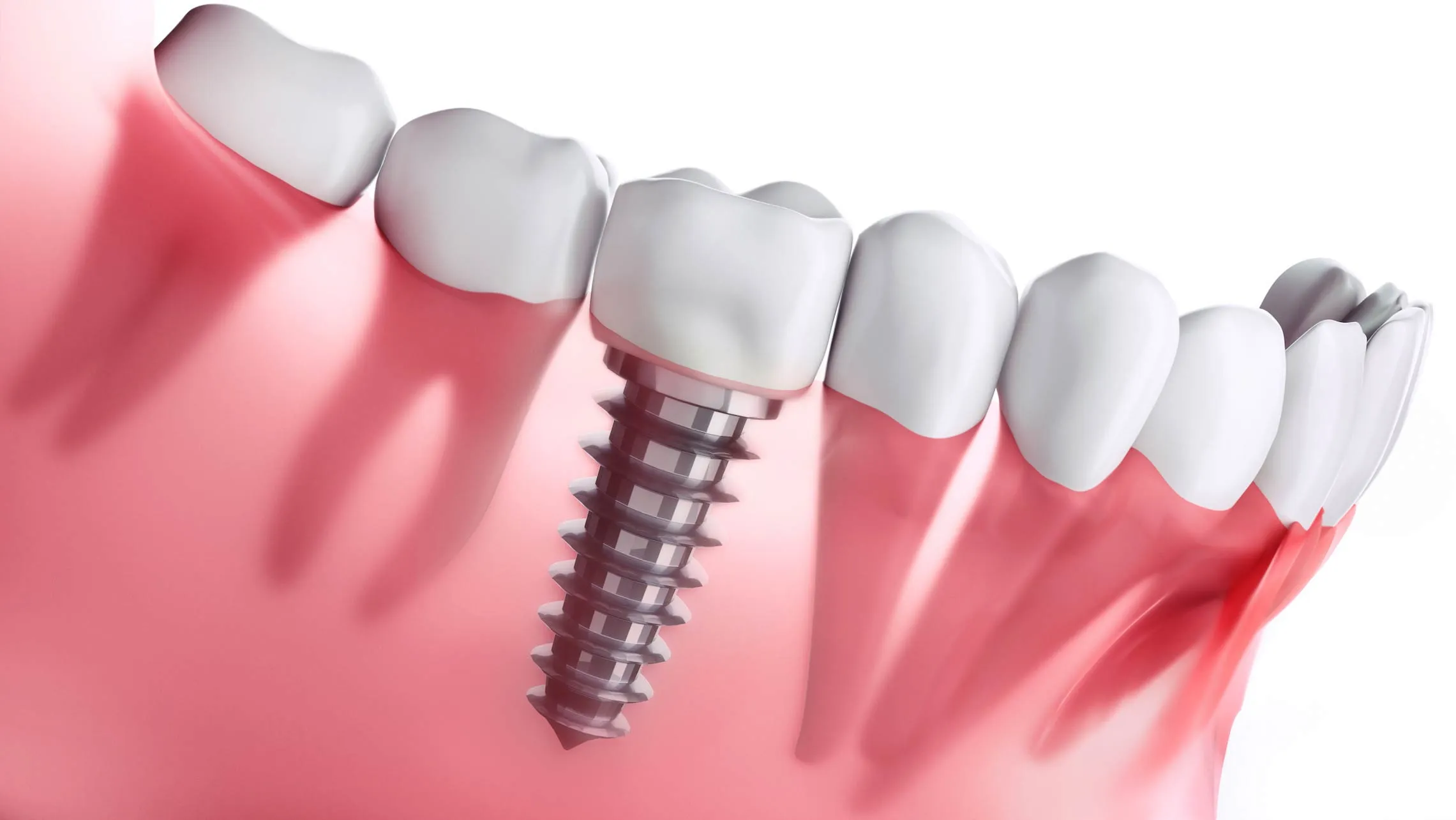 The Art of Dental Implants in Istanbul