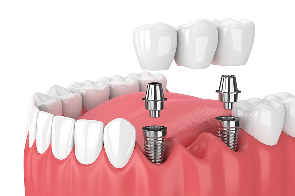Bone Preparation