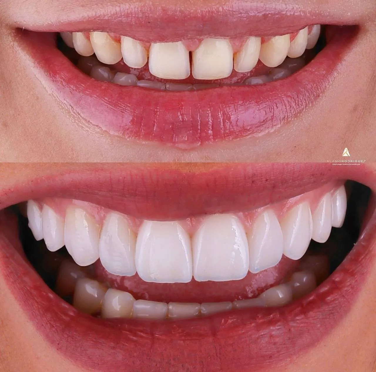 Zirconium crowns in Istanbul