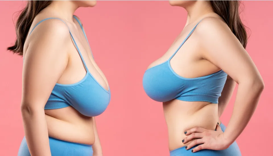 The Art of Breast Lift surgery in Istanbul