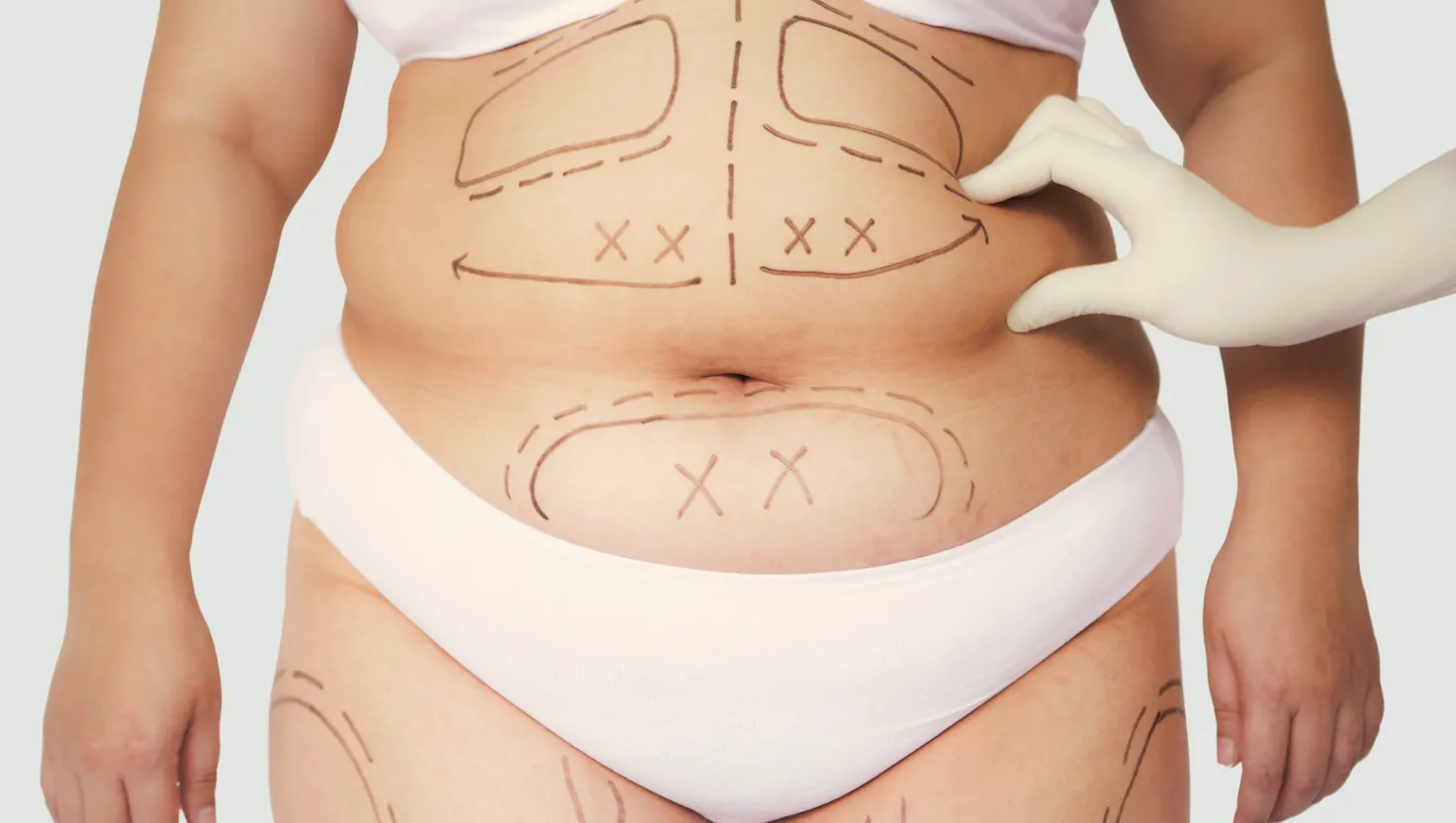 Liposuction 