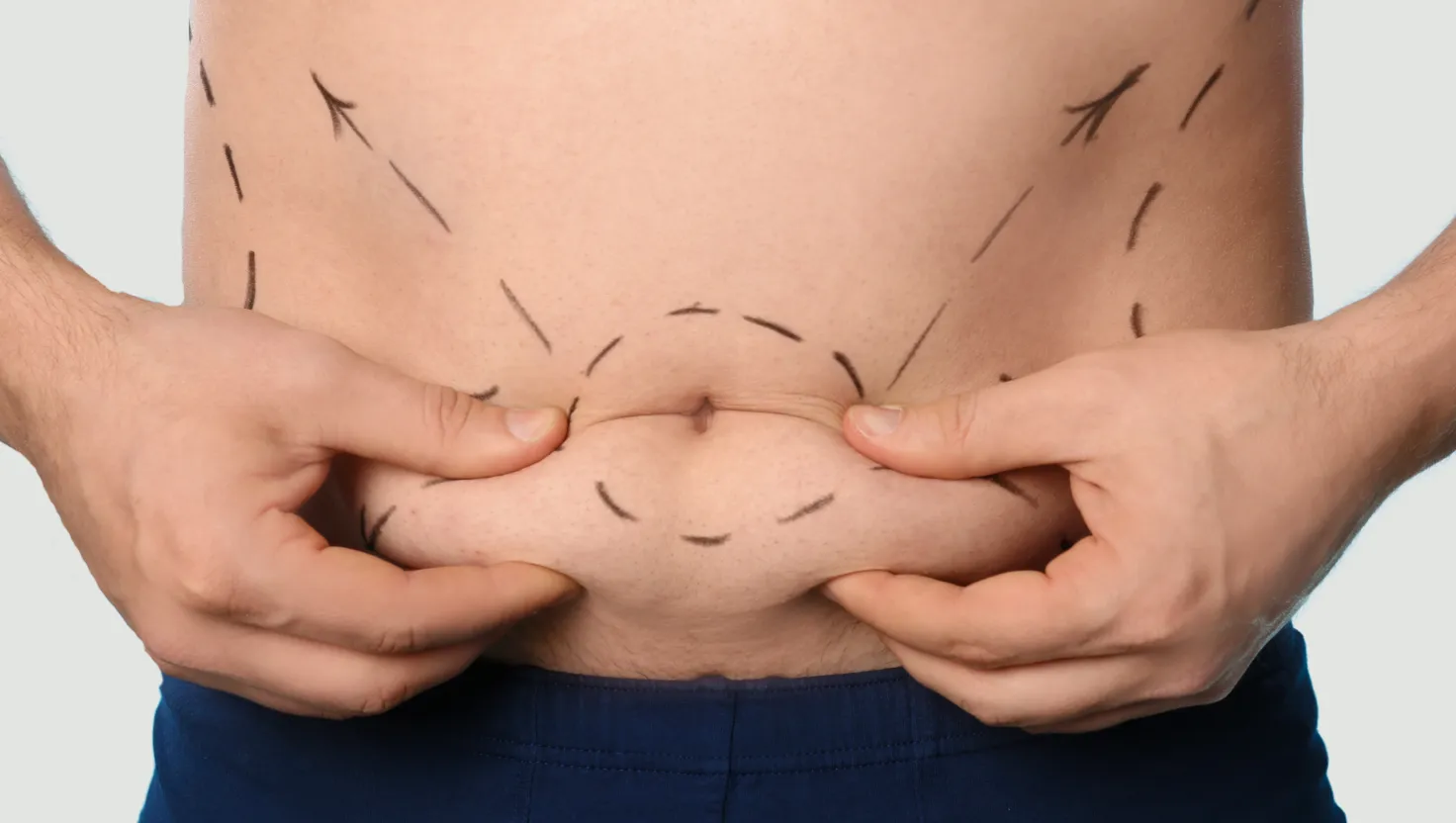 Fat Removal